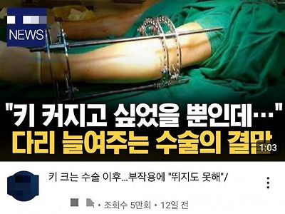 현재 일반인들 사이에서 ‘키수술’ 의 인식