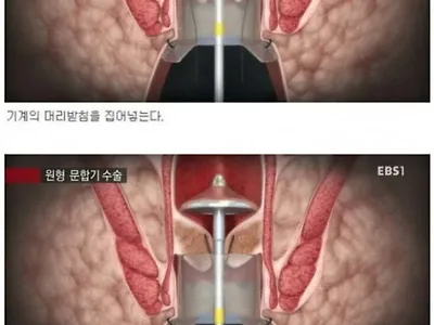 평소에 엉덩이 관리를 잘해야하는 이유