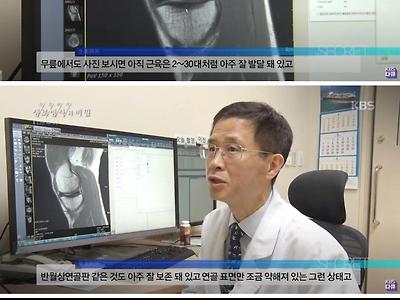 마라톤 1000회 완주한 노인의 무릎상태..jpg