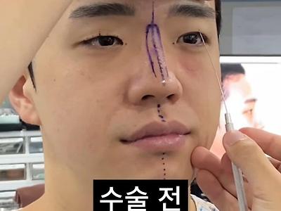 남자 성형수술 전후.jpg