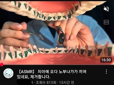 의외로이빨에 껴서 제거해야 하는것 ㄷㄷ