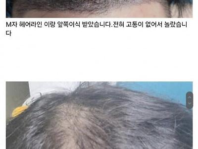 25살 대머리 모발이식 후기