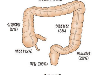 대장암 환자들의 공통적인 습관