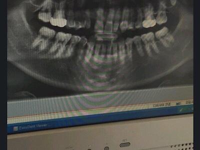 치과의사도 포기한 내치아1