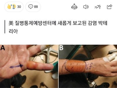 길고양이한테 물린 사람한테 새로운 종류 박테리아 발견 ㄷㄷ