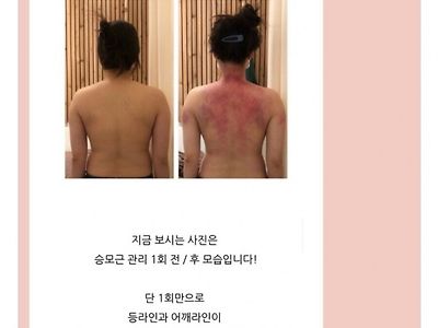 승모근 관리를 통한 자세 교정