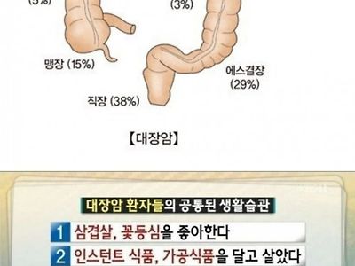 대장암 환자들의 공통된 생활습관