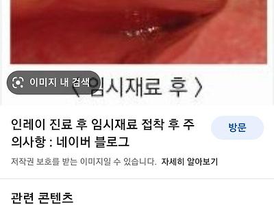 치과 인레이전 임시충전재 비용이 십만원이나 하나요?