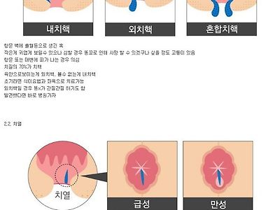 현대인들의 질병 치질..jpg
