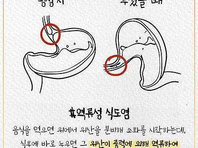 먹고 바로 누워있으면 위험한 이유