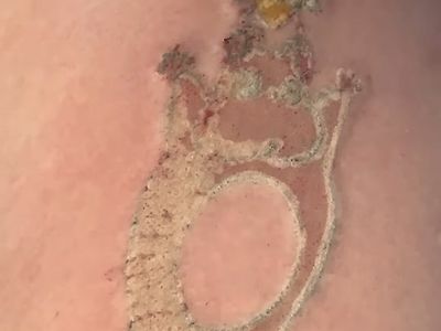 약혐) 귀여운 문신제거 시술하는 영상......GIF