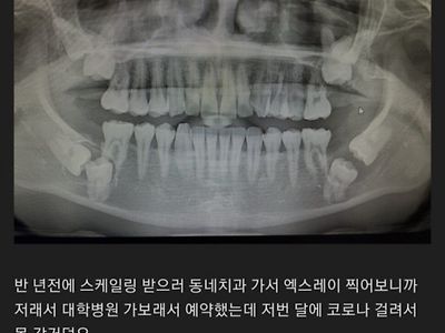 매복사랑니 레전드 그리고 병원 후기