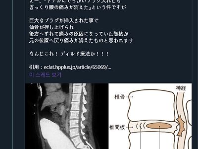 척추 디스크 치료 방법류