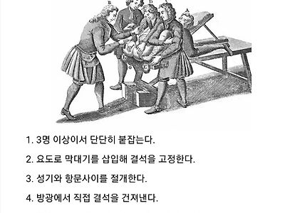 과거의 요로결석 제거 방법