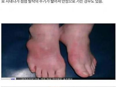 참을 수 없는 통풍의 고통