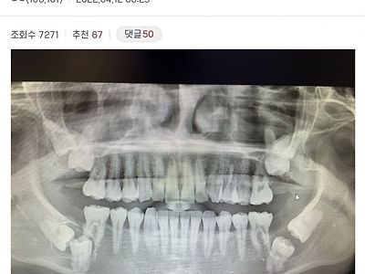 역대급 사랑니라는 디씨인 근황(혐)