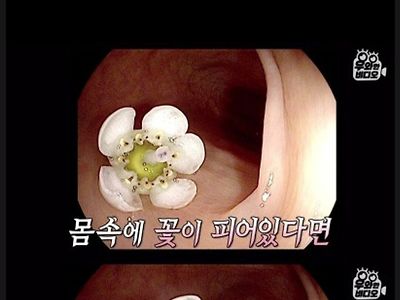 대장내시경 중 몸 안에서 발견된 것