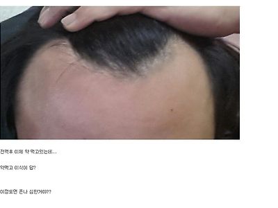 탈모가 무서운 이유.jpg