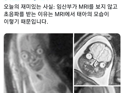 태아 사진을 MRI가 아닌 초음파로 찍는 이유.JPG