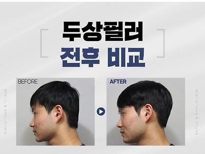 남자들이 의외로 많이하는 성형.jpg