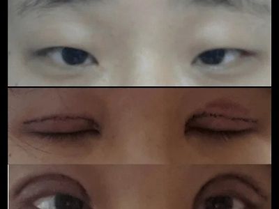 쌍커풀 수술 레전드