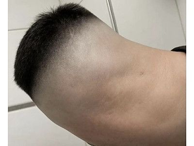 12개월차 모발 이식 후기