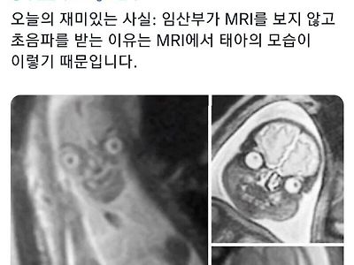 태아 사진을 MRI가 아닌 초음파로 찍는 이유.jpg