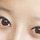 <b>매몰</b>+앞트임 했는데 앞트임이 너무 많이 된거맞죠?ㅜ
