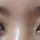 저같은 눈은 어떻게해야되나요?