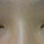 아직도붓기때문일까요...쌍수<b>매몰</b>후짝짝이