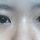 비절개눈매교정,...어떻하죠?풀어야하나여?