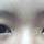 비절개눈매교정+<b>매몰</b> 푼 후 눈 상태올려바요..ㅠㅠ