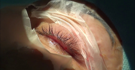 Cirurgia de calazio