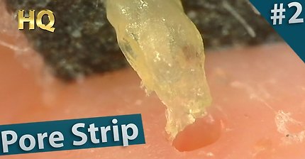 #2 Pore Strip Close up - Blackheads Removal