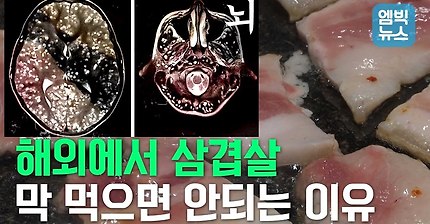 삼겹살 먹다 감염된 기생충이 뇌와 척수까지 | 인스티즈