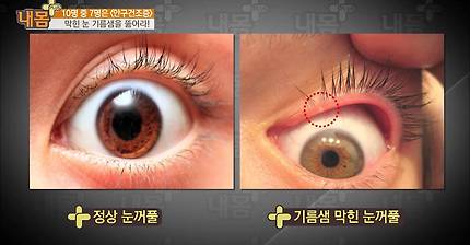 안구건조증! 1분이면 해결! [내 몸 사용설명서 플러스] 3회 20160424