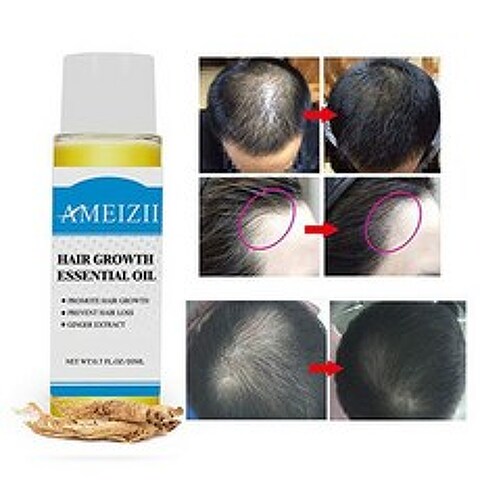 Cutelove Hair Growth Essence Oil Serum Liquid Hair Loss Hair Regrowth For Men and Women 20ml Dense, 1# Upgraded version, 상세 설명 참조0