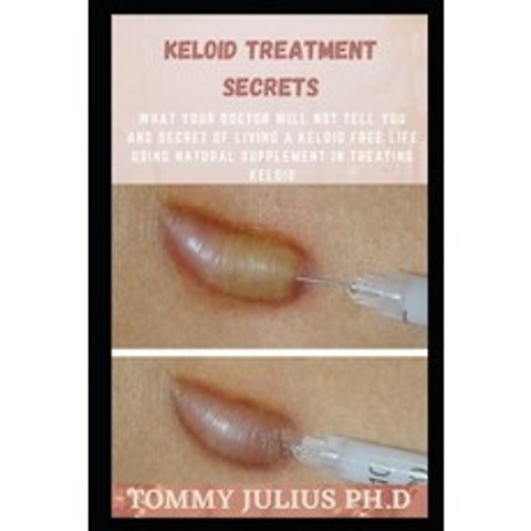 (영문도서) Keloid Treatment Secrets: What Your Doctor Will Not Tell You and Secret of Living a Keloid Free Life... Paperback, Independently Published, English, 9798592871504
