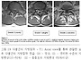 허리디스크 예후를 보여주..