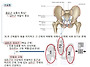 천골통을 만드는 핵샘 근육..