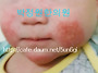 55 아기 아토피치료(생후 ..
