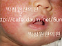 47 아토피치료 (얼굴 정면..