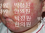 56 아기 아토피치료(생후 ..