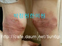 40 아토피치료 (무릎 뒤)..