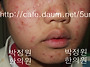 48 아토피치료 (얼굴 정면..