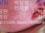54 아기 아토피치료(생후 ..