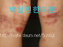 39 아토피치료 (무릎 뒤)..