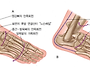 족저근막염 운동시 고려할..