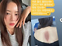 “신혼여행에서 화상” 박..