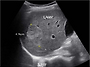 Hepatic hema..